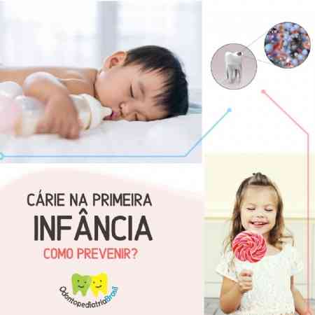 Prevenção da Cárie em Bebês de 1 Ano Dicas e Recomendações Bebé da